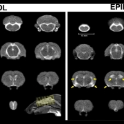 30 years of post-traumatic epilepsy research: Where do we stand?